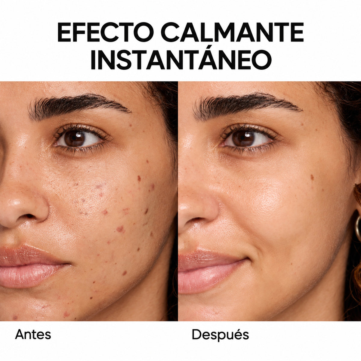 Reduce tus brotes y puntos negros en solo 14 días