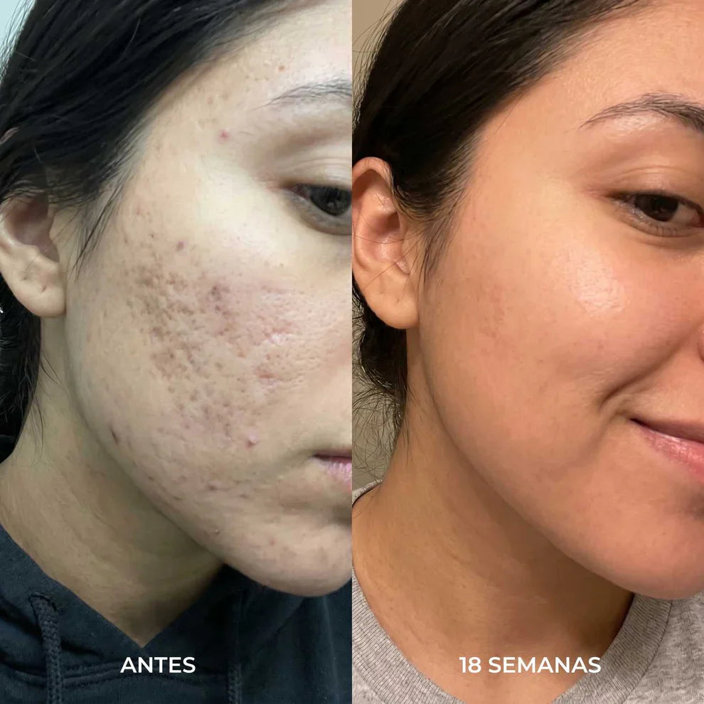 Stick Reparador de cicatrices de acne