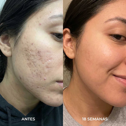 Stick Reparador de cicatrices de acne