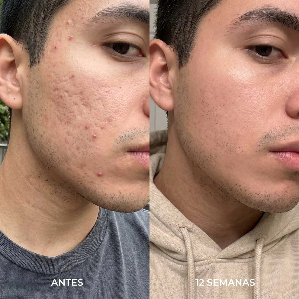 Stick Reparador de cicatrices de acne